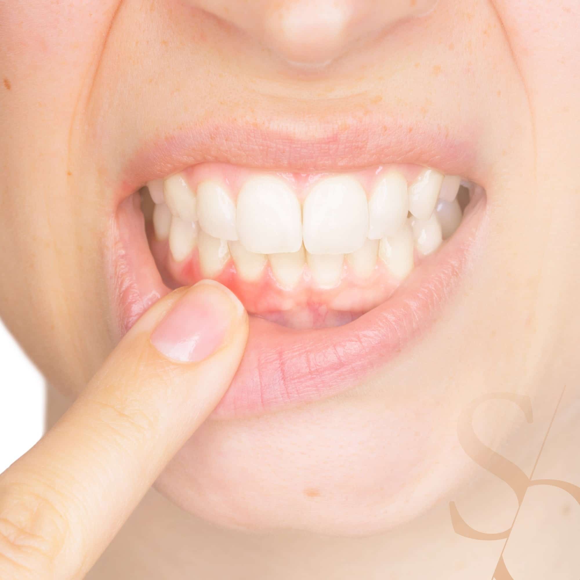 Gingivite : causes et traitements | Parodontie | Clinique dentaire Sana Oris Paris 8