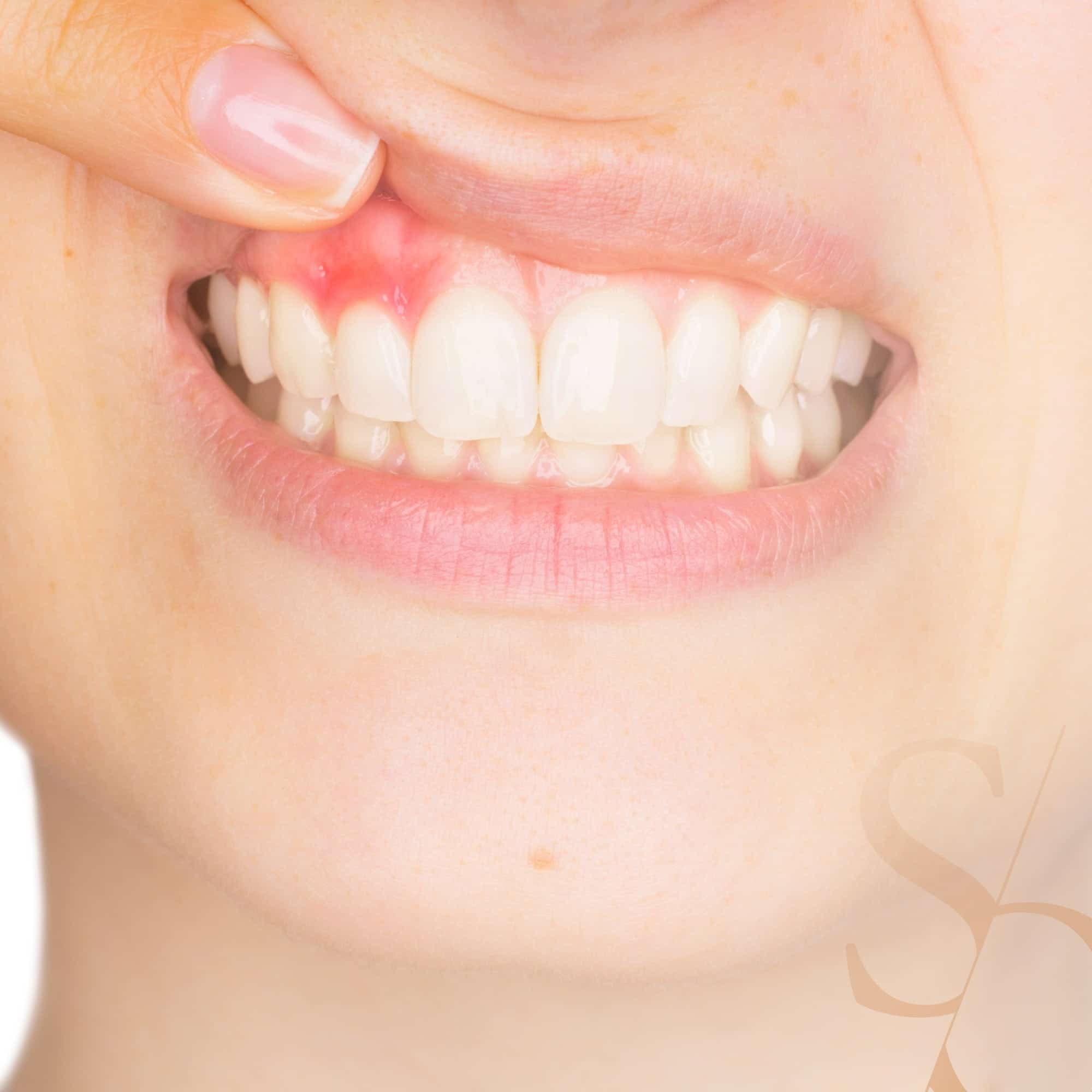 Parodontite : causes, traitements et tarifs | Gingivite sévère | Clinique dentaire Sana Oris Paris 8