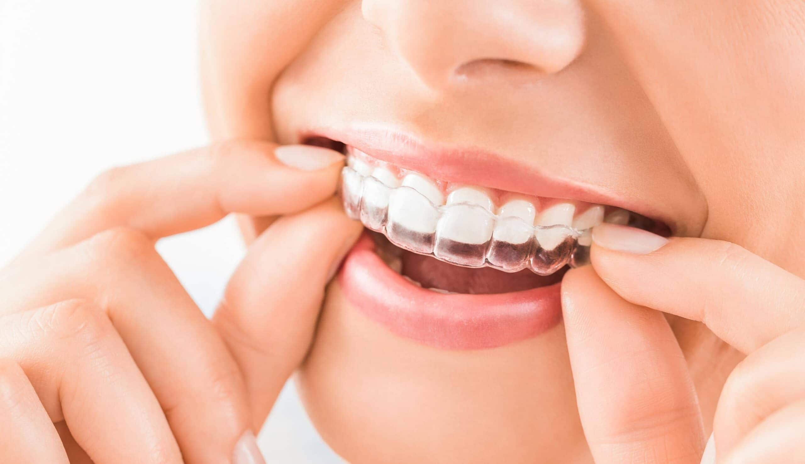 Quel est l’âge idéal pour débuter un traitement d’orthodontie ? | Clinique dentaire Sana Oris | Paris 8