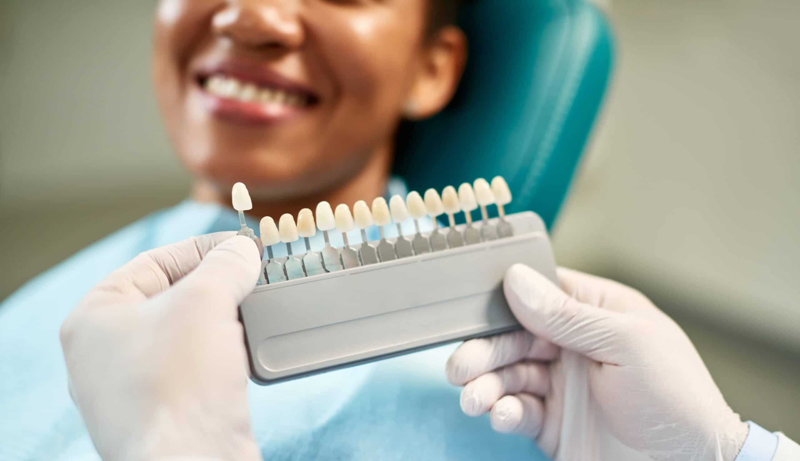 Facettes dentaires : quelle durée de vie ?| Clinique dentaire Sana Oris | Paris 8