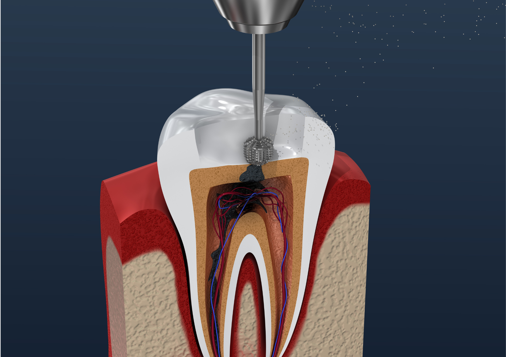 En quoi consiste le traitement endodontique chez Sana Oris ?