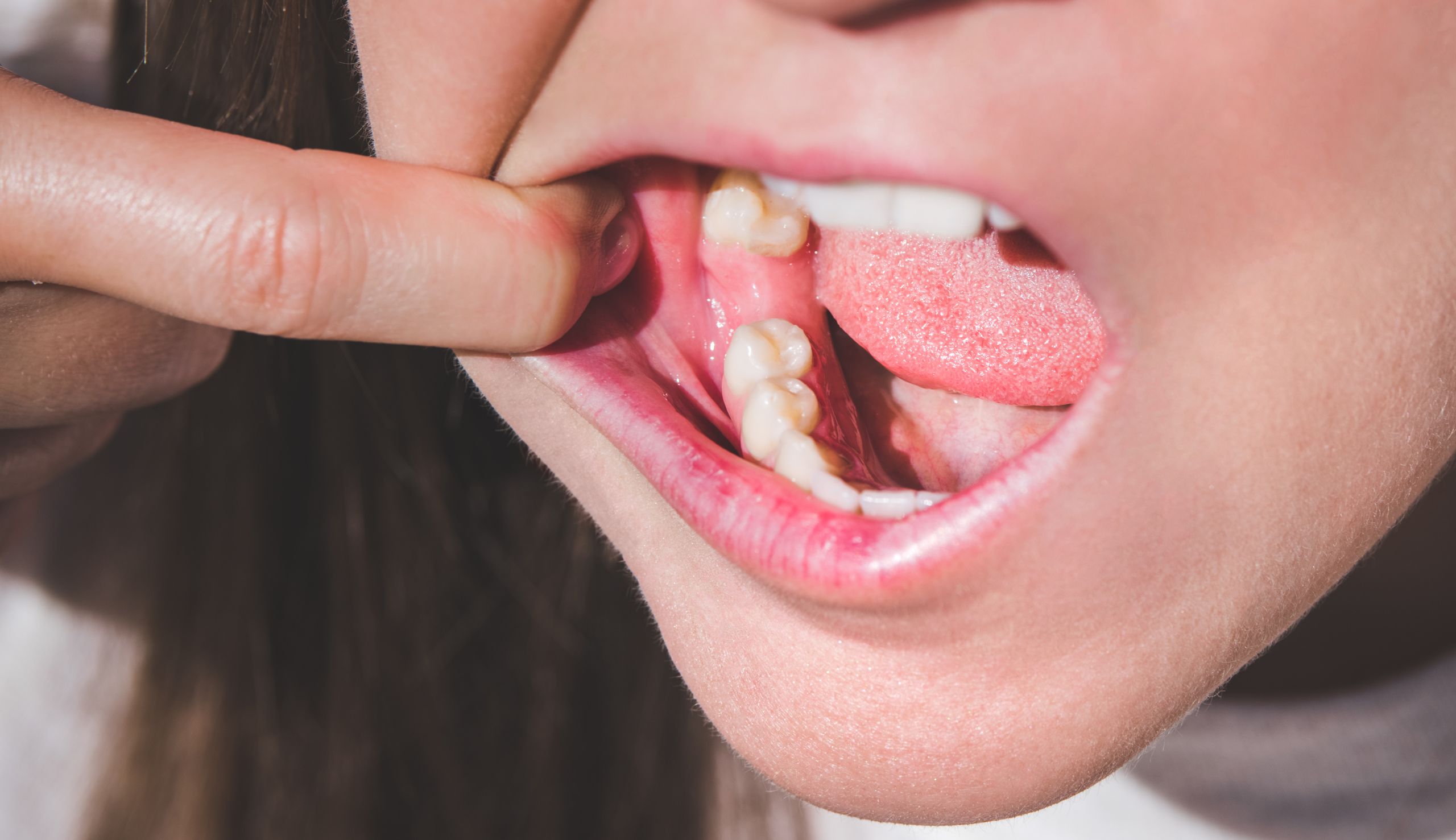 Quelles solutions dentaires choisir en cas d’une ou plusieurs dents manquantes ? | Clinique dentaire Sana Oris | Paris